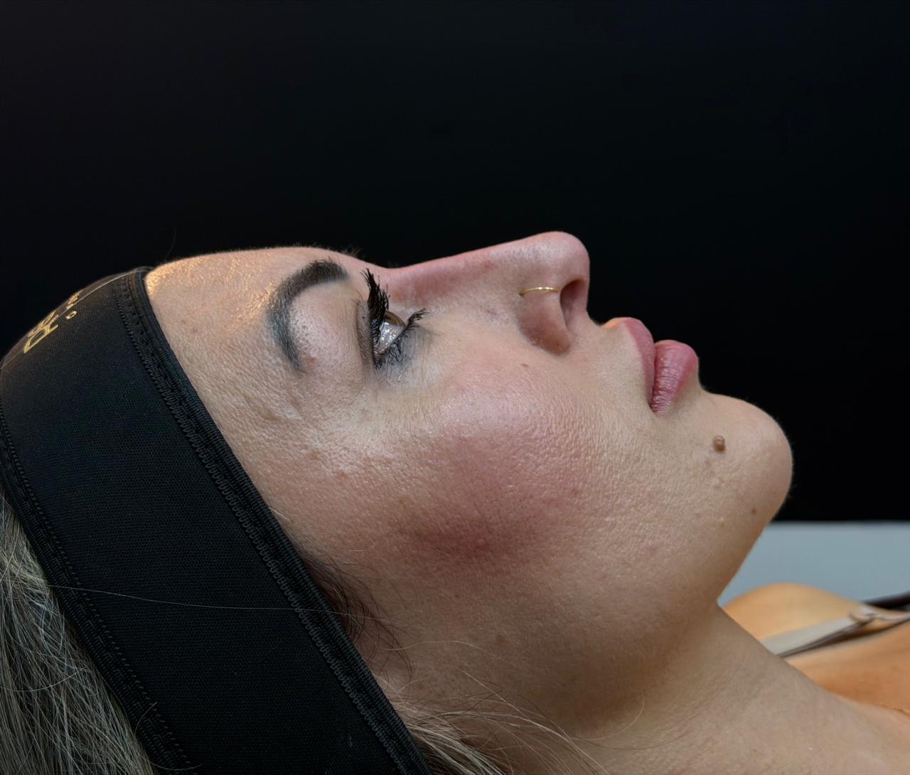 Perfiloplastia — perfil facial harmonizado